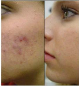 Un-retouched before and after pic of our customer Sarah. Before and After unretouched image of Sarah